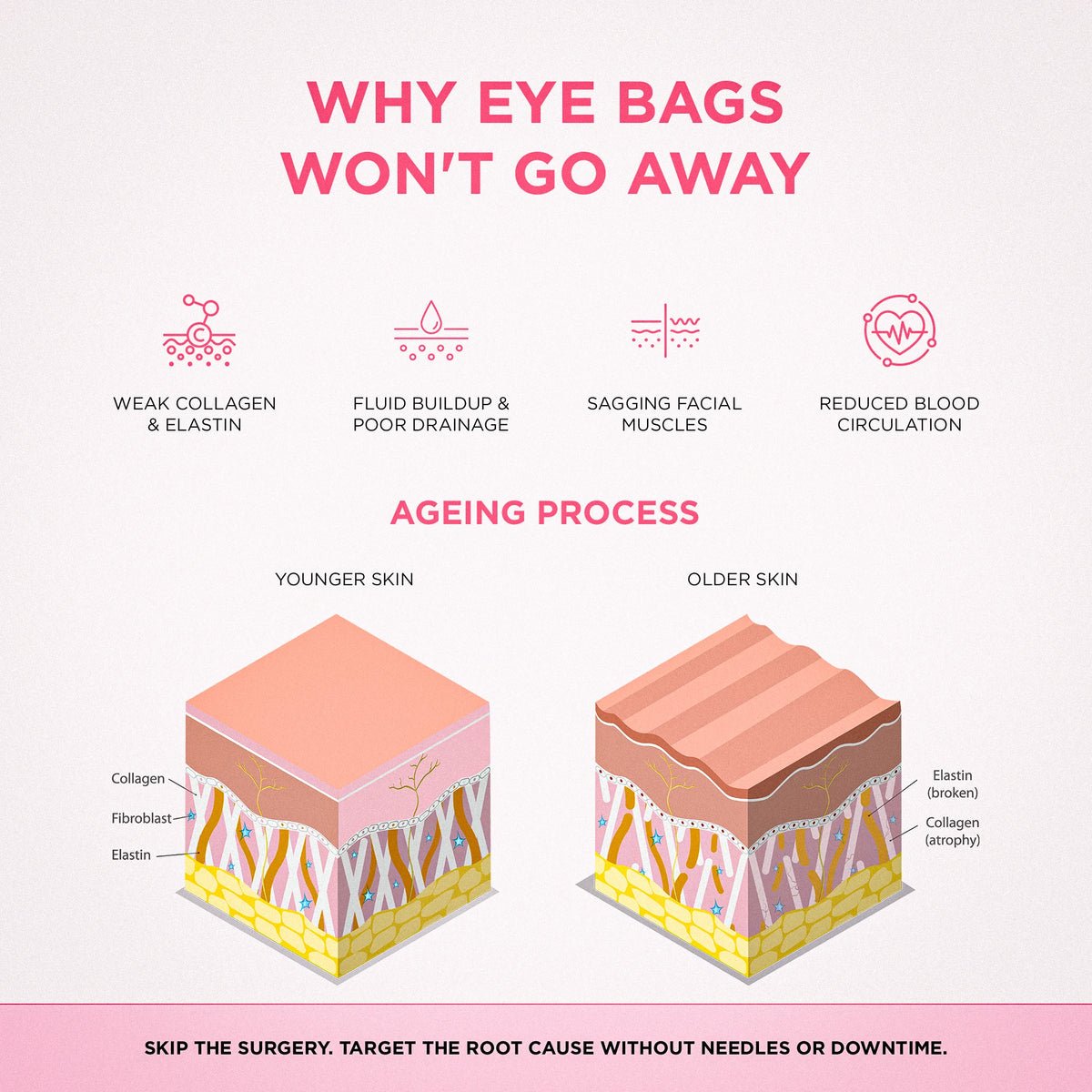 Why eye bags form
