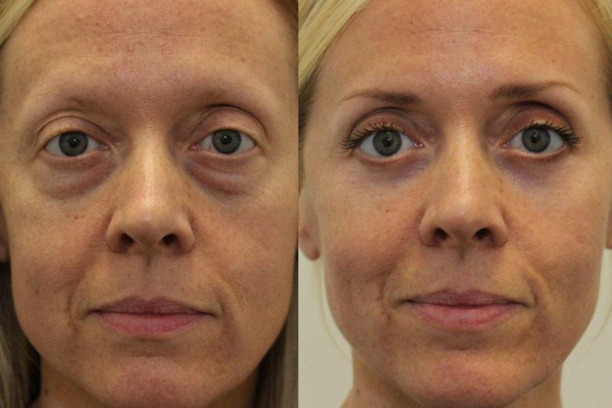 Customer before and after using LIFT.