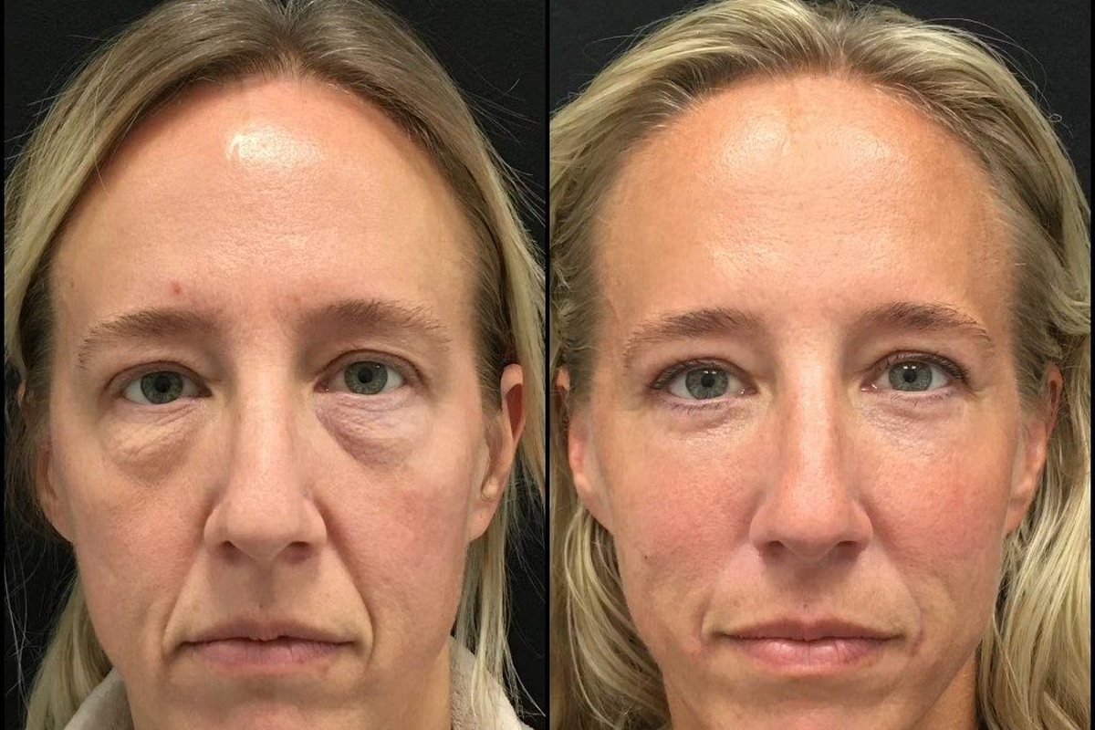 Customer before and after using LIFT.