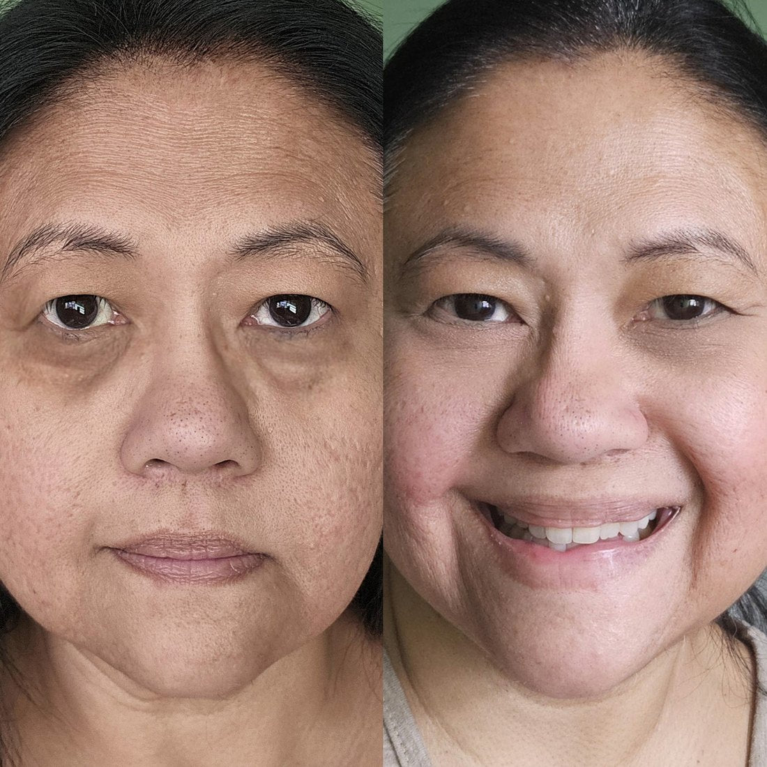 Gabrielle P. before and after using LIFT.