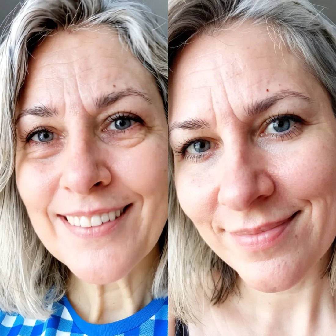 Arlene W. before and after using LIFT.